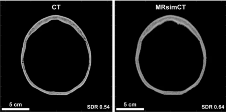Improving Focused Ultrasound Brain Treatments with MRI Imaging ...
