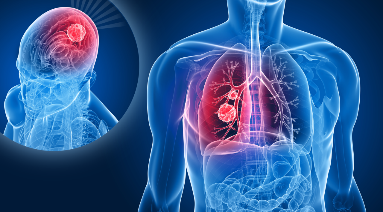 lung-cancer-brain-metastases-multisite-focused-ultrasound-and