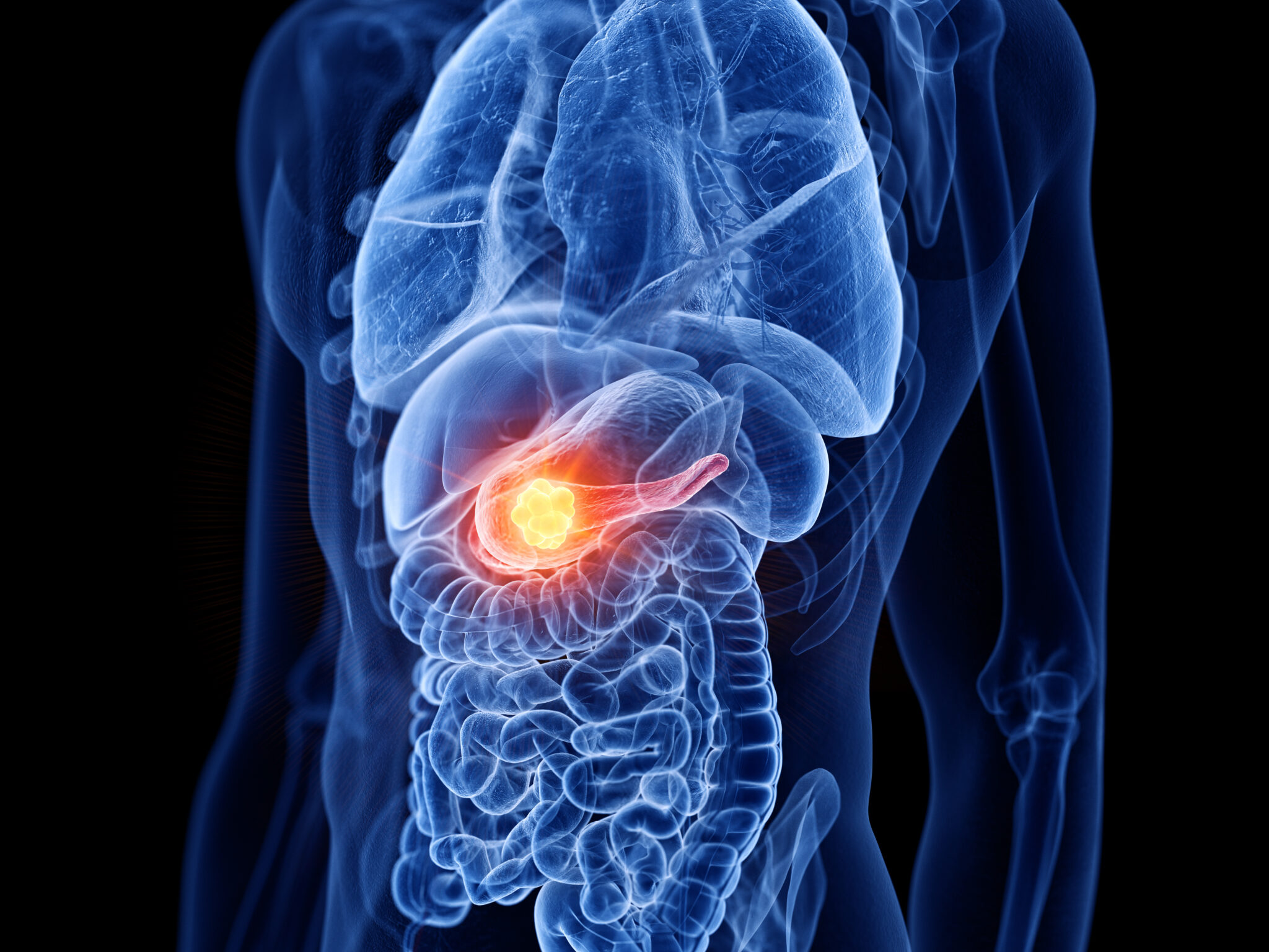 Pancreatic Cancer: Focused Ultrasound Clinical Trial Begins in the US ...