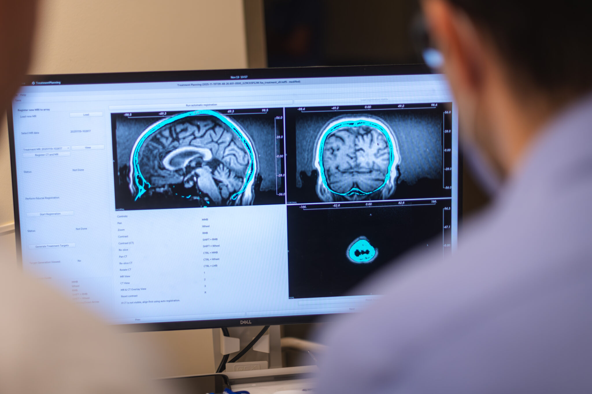 How the Transdermal Patch Targets Aggressive Brain Cancer